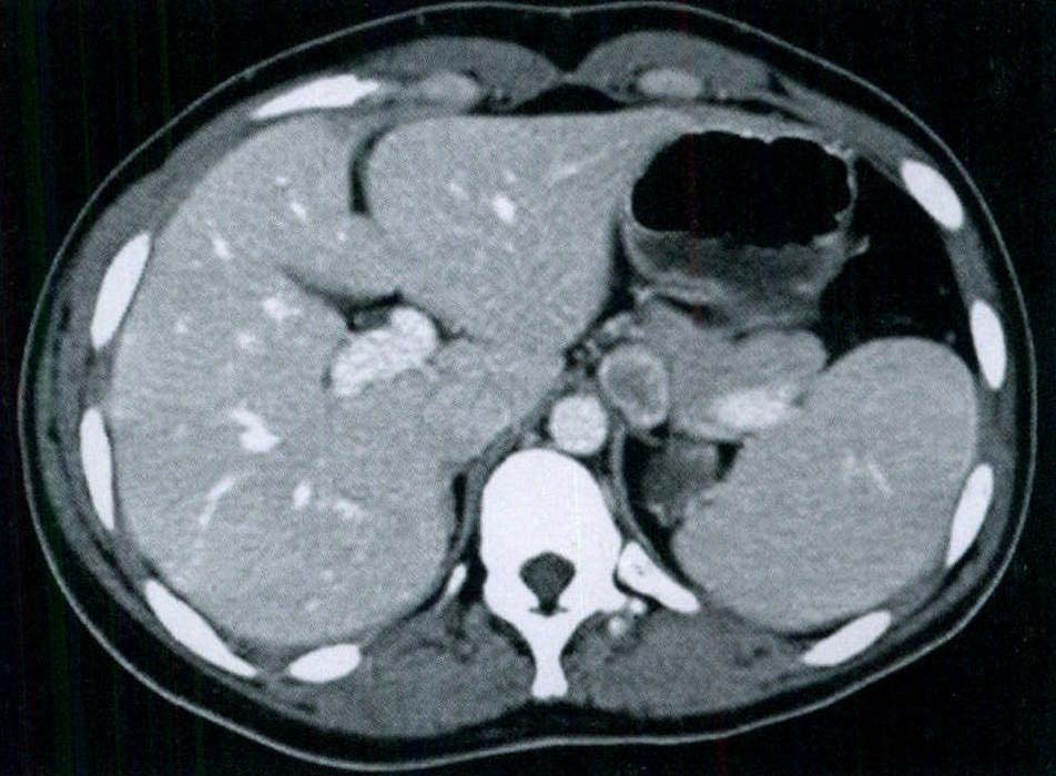 胰腺囊實乳頭狀腫瘤(病例1~3)